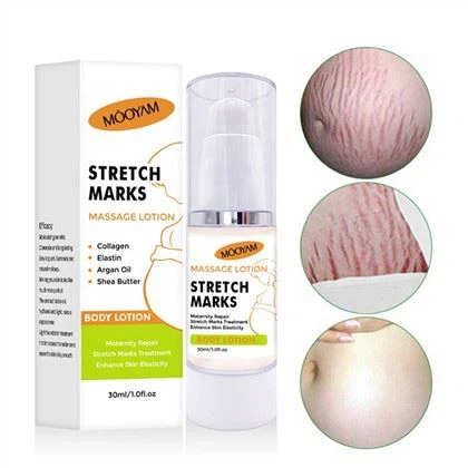Stretch belgilarini olib tashlash uchun samarali krem